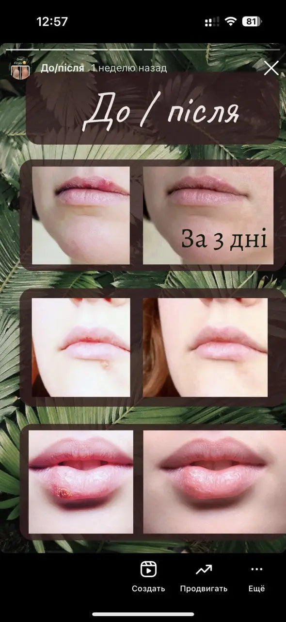 Бальзам АНТИГЕРПЕС («лихоманка» на губах) 5мл