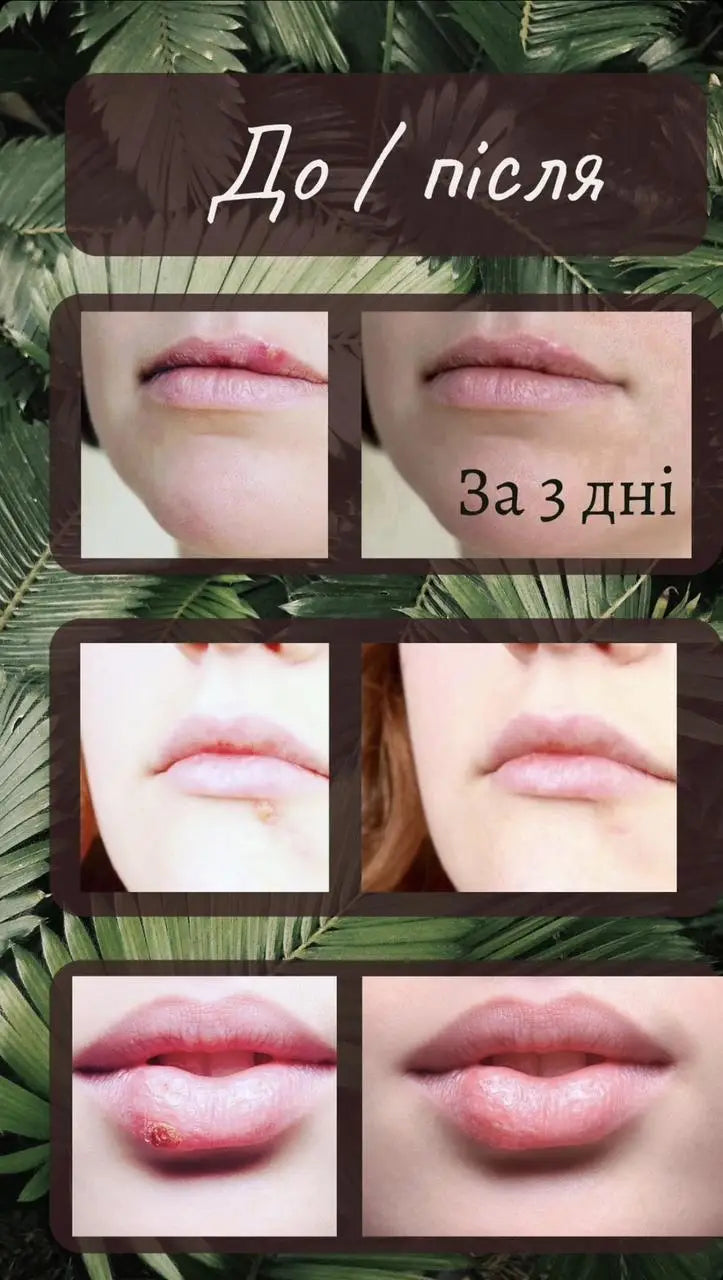 Бальзам АНТИГЕРПЕС 15мл («лихоманка» на губах)